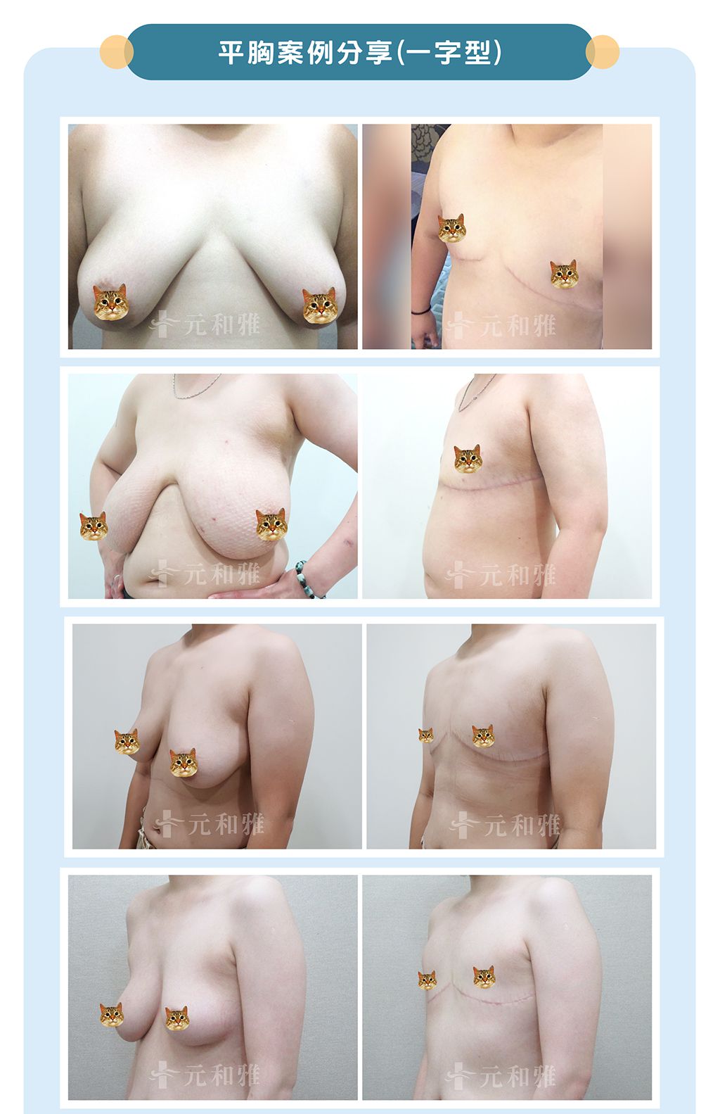 平胸手術/術前術後